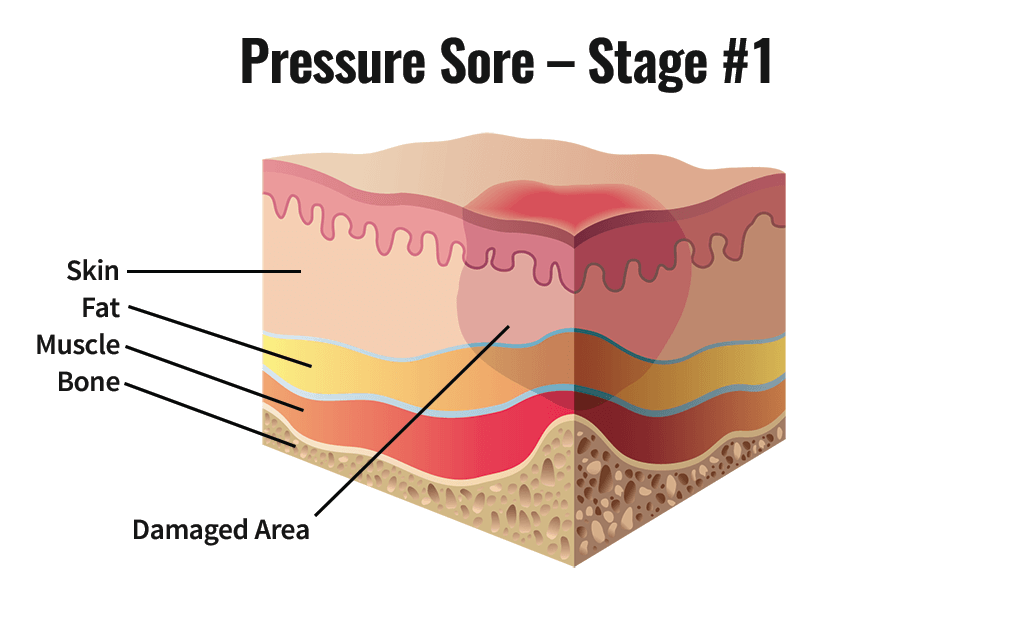 Stage One Pressure Sore