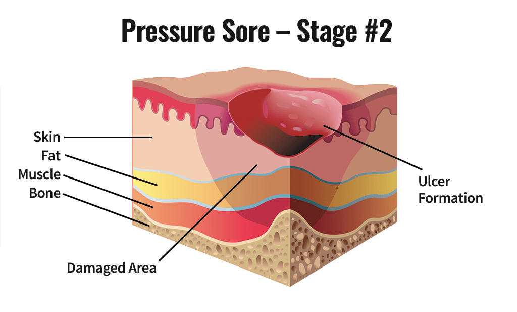 Stage Two Pressure Sore