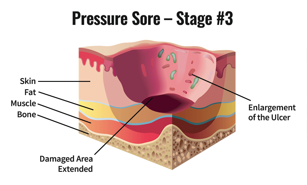Stage Three Pressure Sore