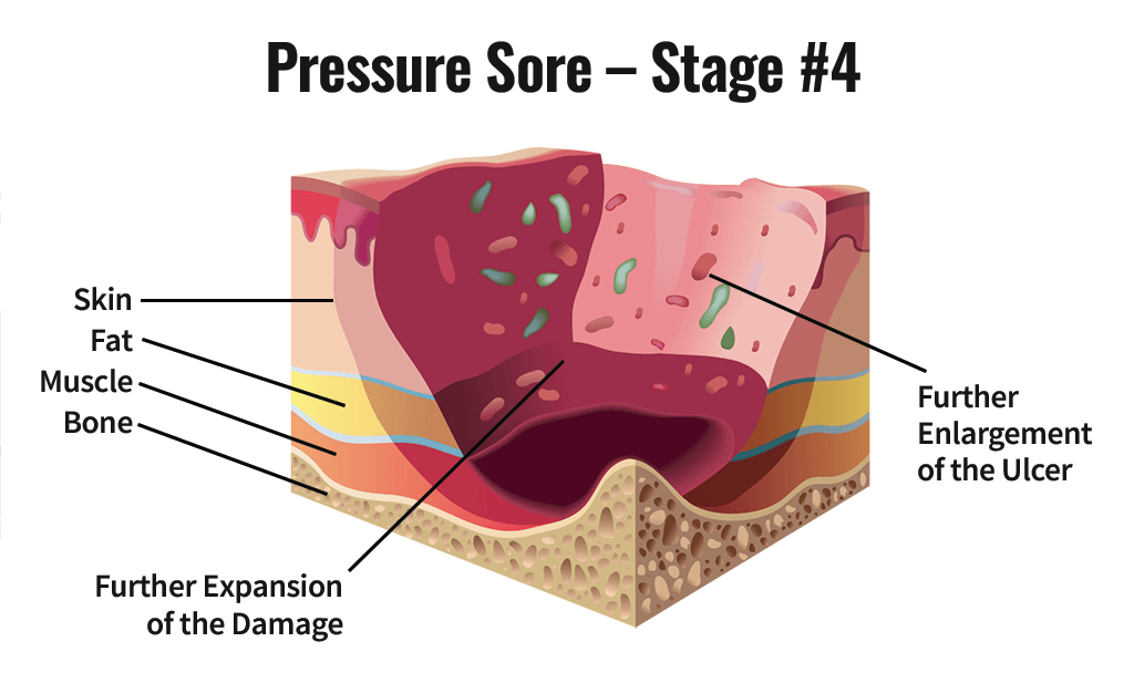 Stage Four Pressure Sore